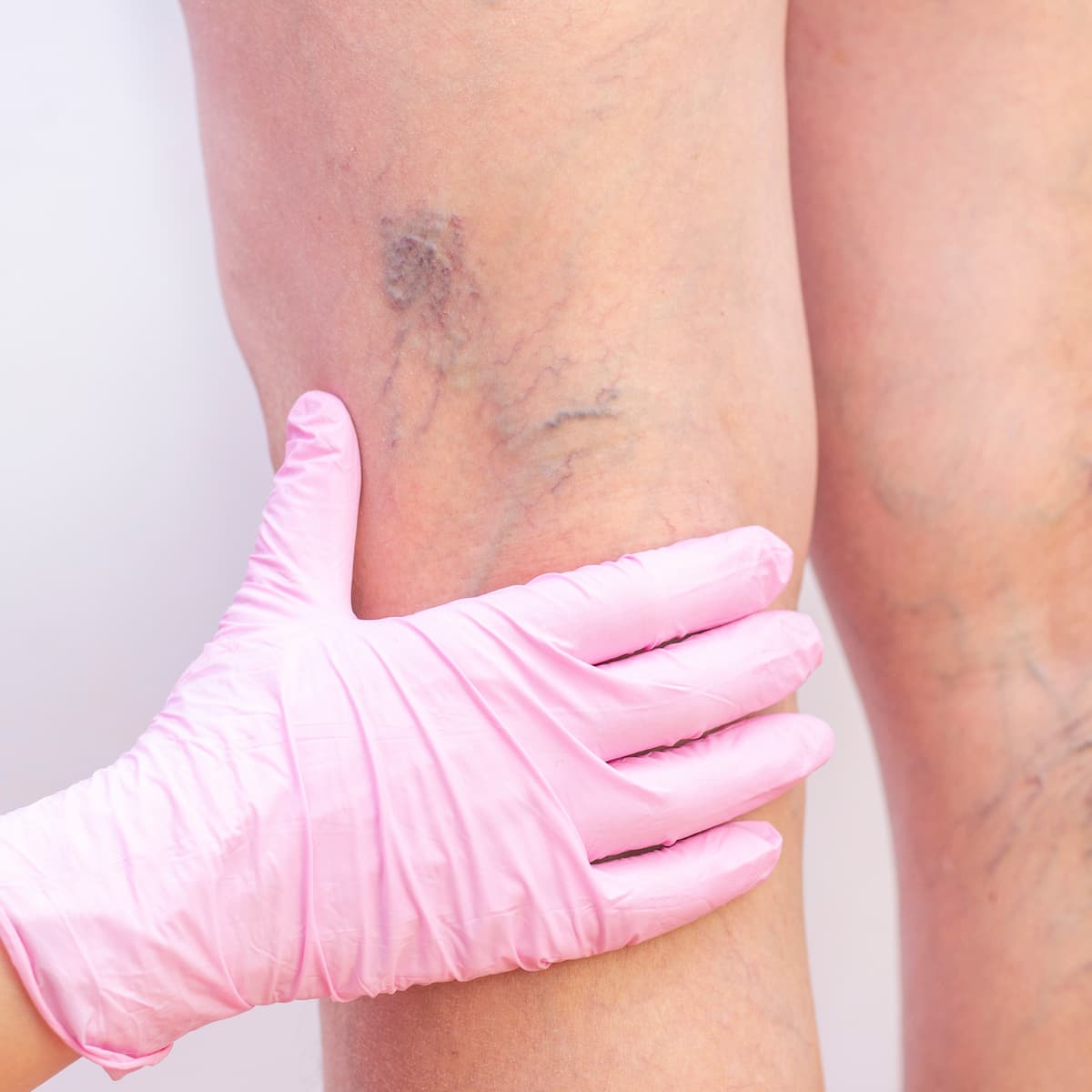 Endovenous Laser Treatment (EVLT) - EVLT in Tampa EVLT in Tampa