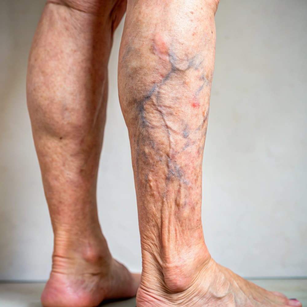 Sclerotherapy for Spider Veins Sclerotherapy for Spider Veins