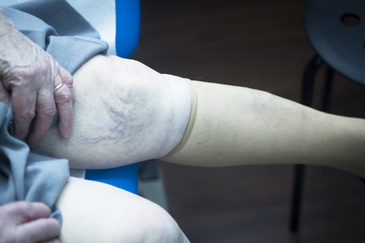 Compression Therapy - compression therapy benefits compression therapy benefits
