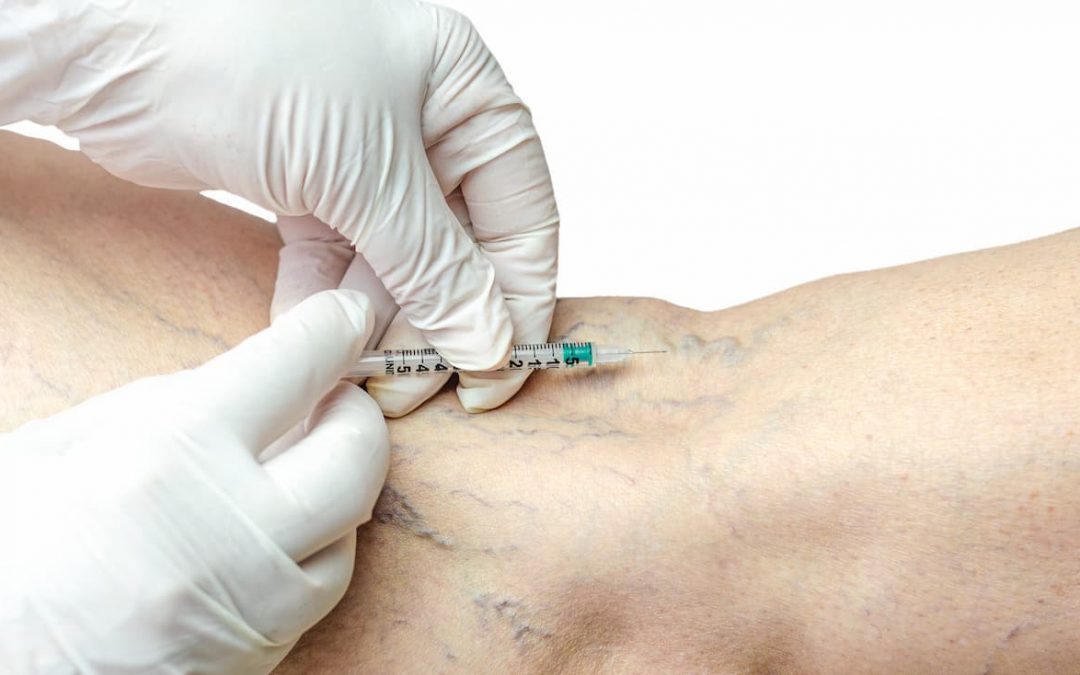 Sclerotherapy for Spider Veins