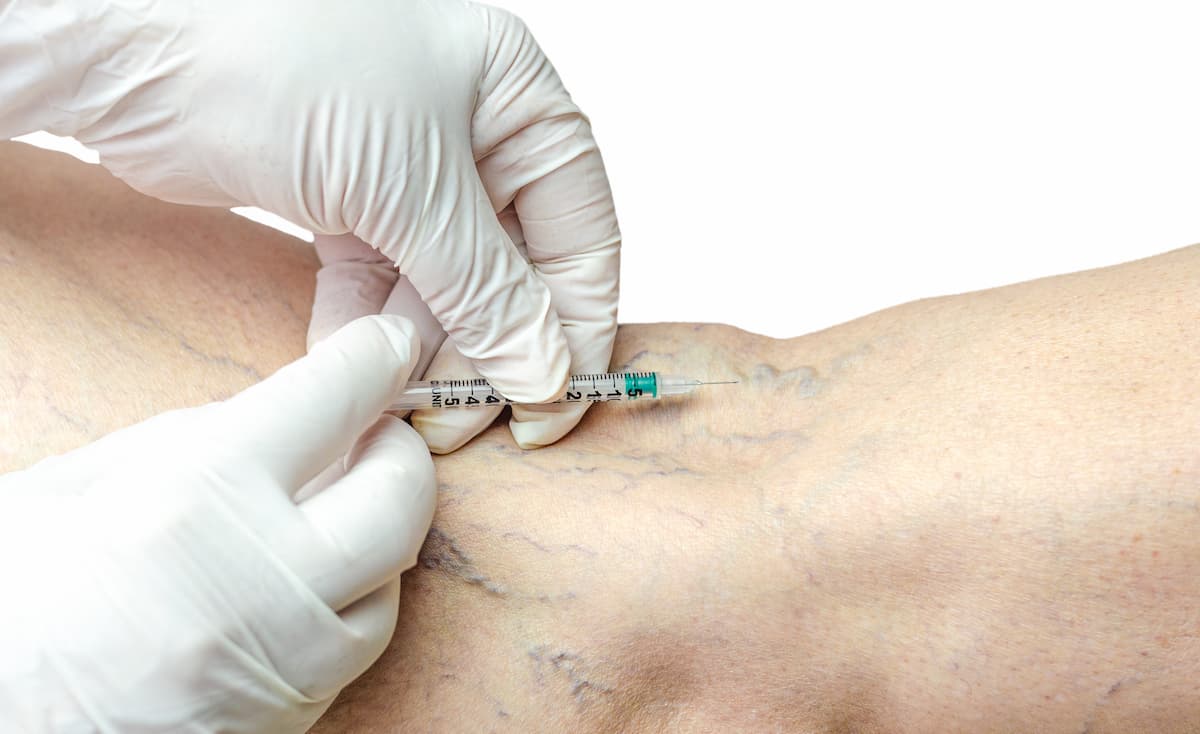 Sclerotherapy for Spider Veins Sclerotherapy for Spider Veins