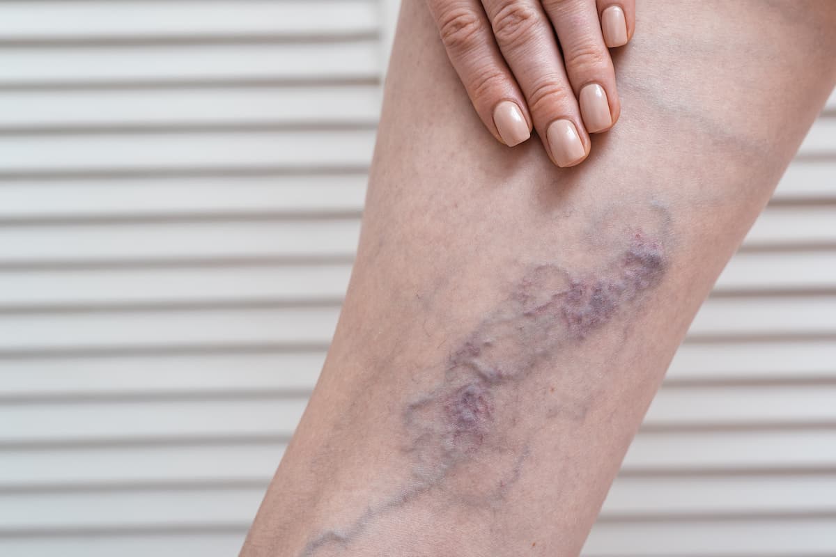 Contact Us - Vein Specialist in fl Vein Specialist in fl