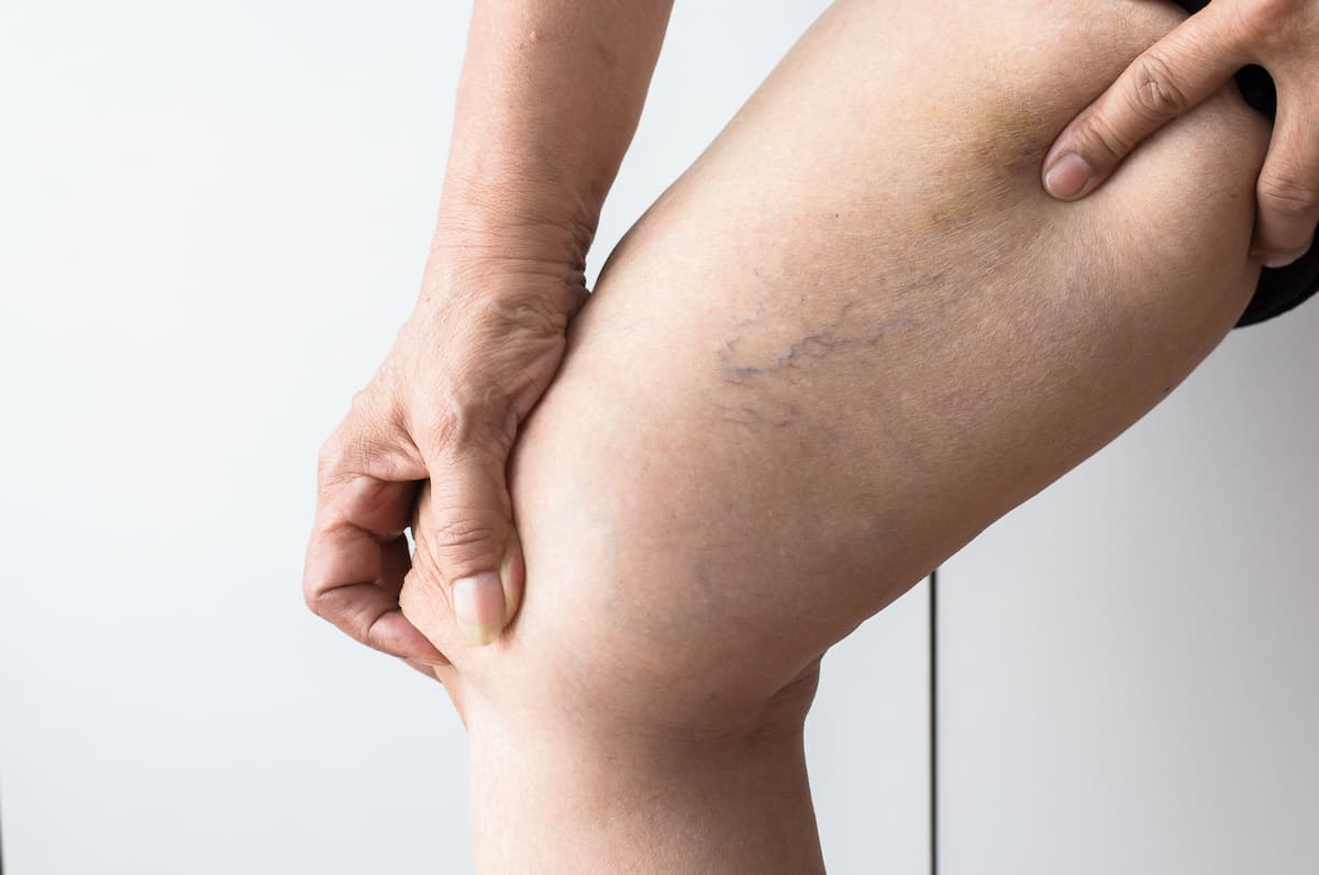 vein conditions