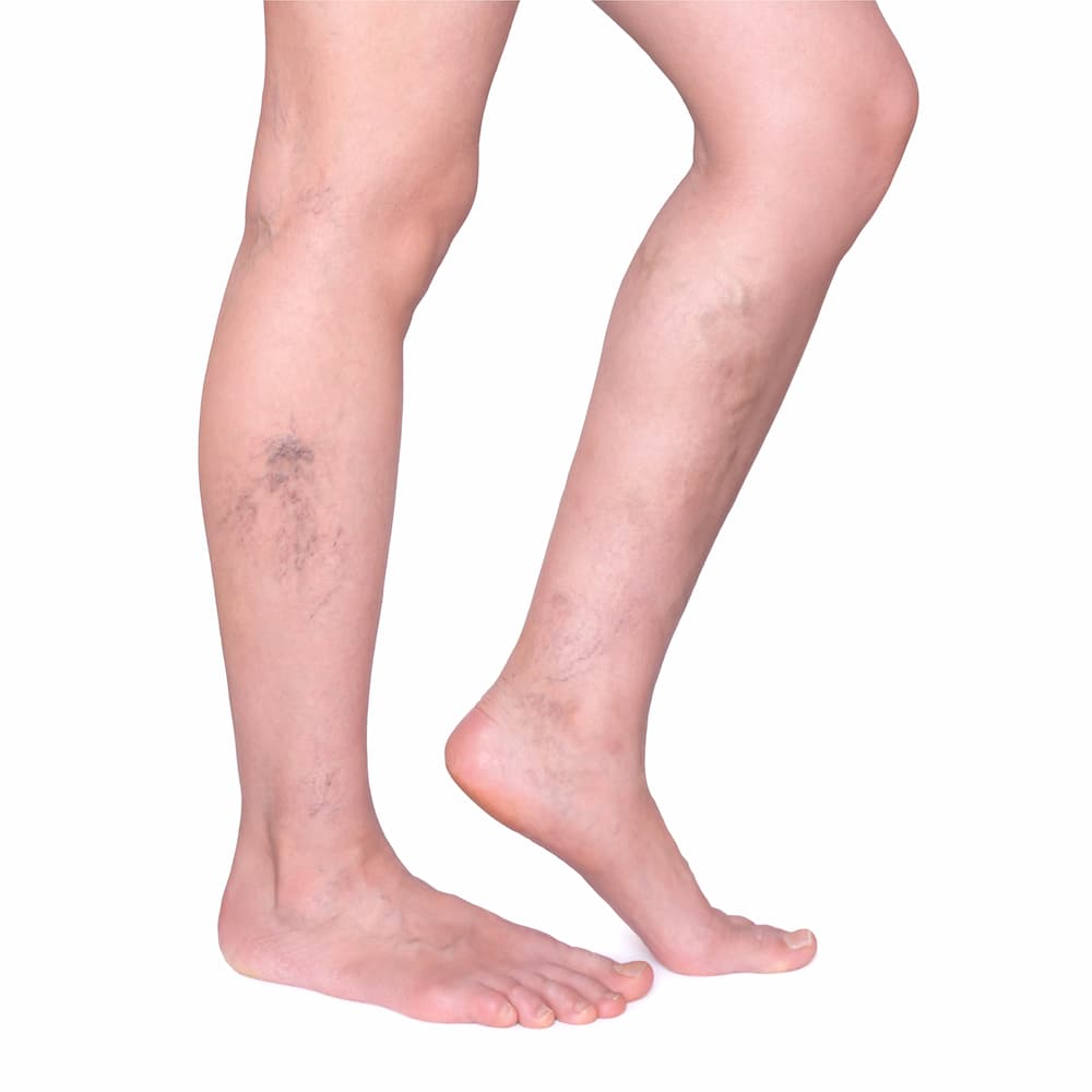 Radiofrequency Ablation (RFA) - Radiofrequency Ablation in Tampa Radiofrequency Ablation in Tampa
