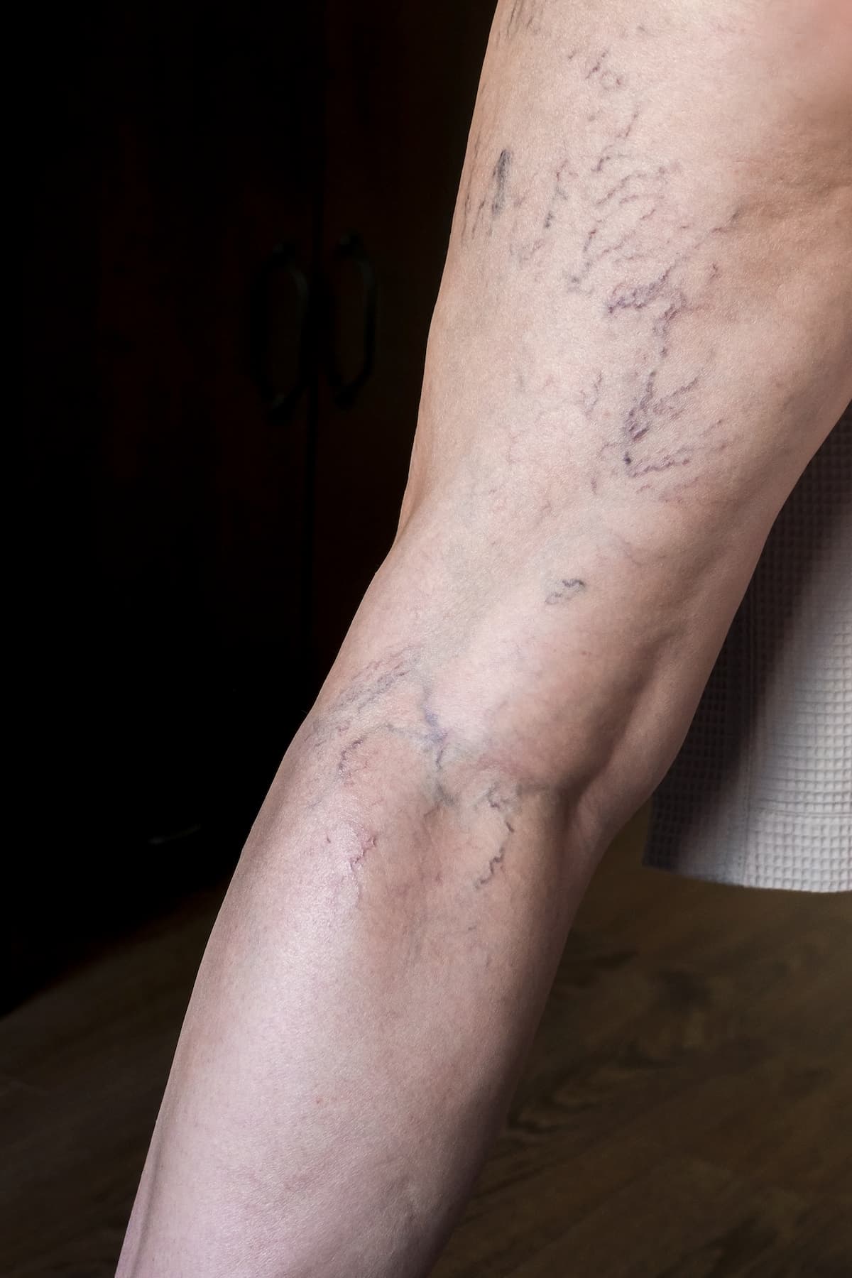 Varicose Vein