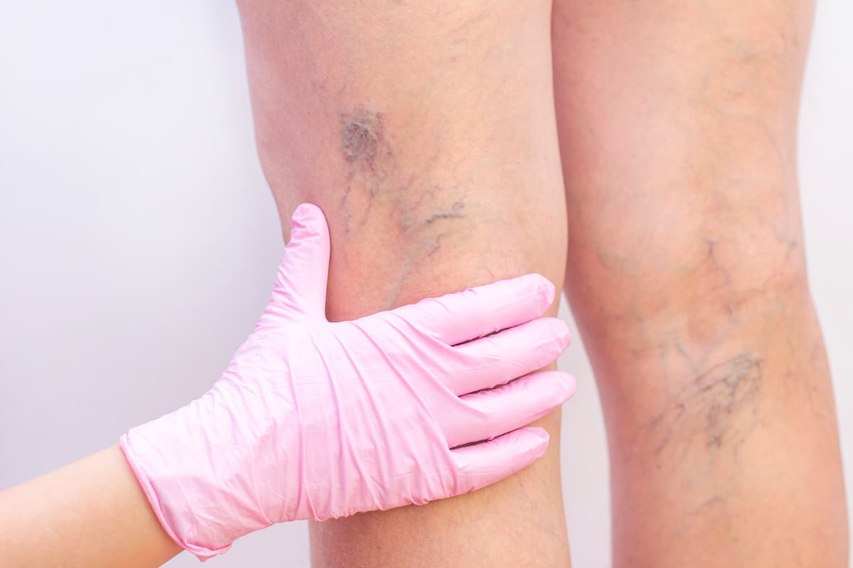 female-legs-with-varicose-veins-1.jpg