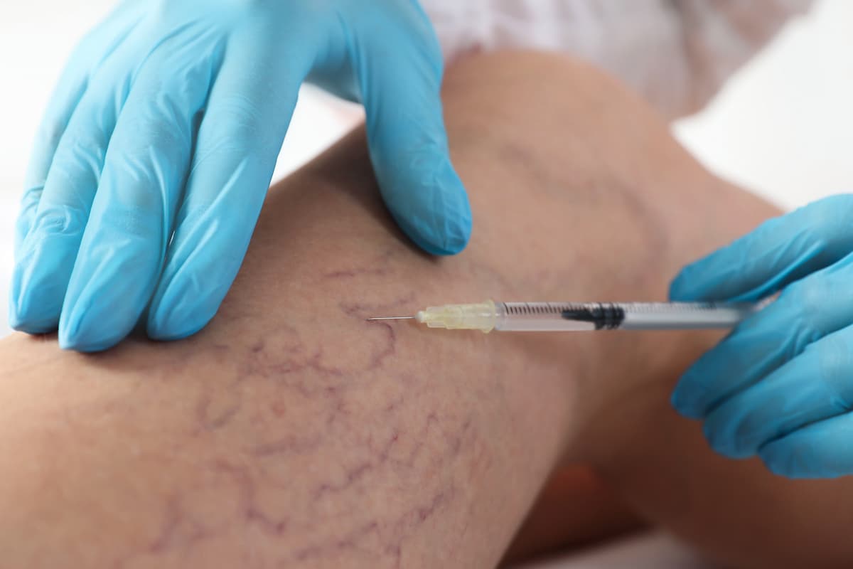 Varicose Vein